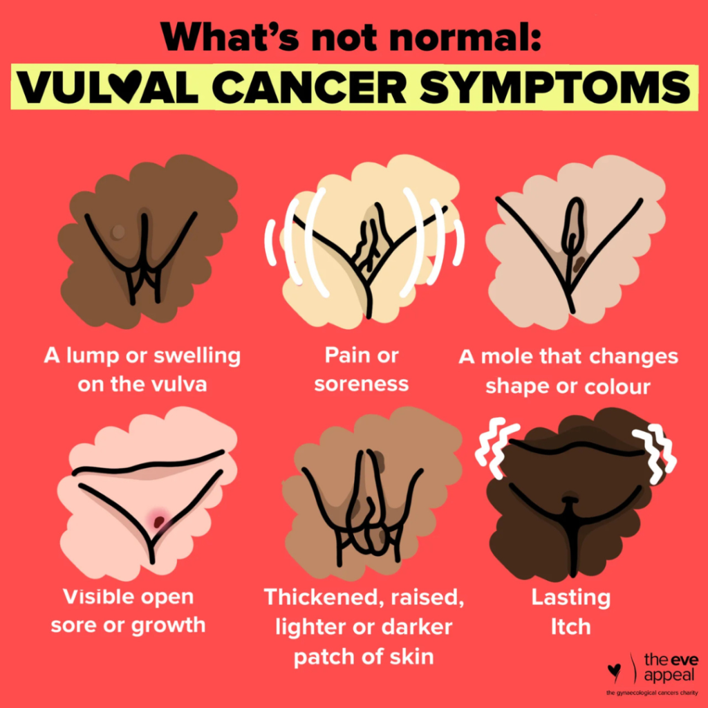 vulval cancer symptoms eve appeal social post infographic