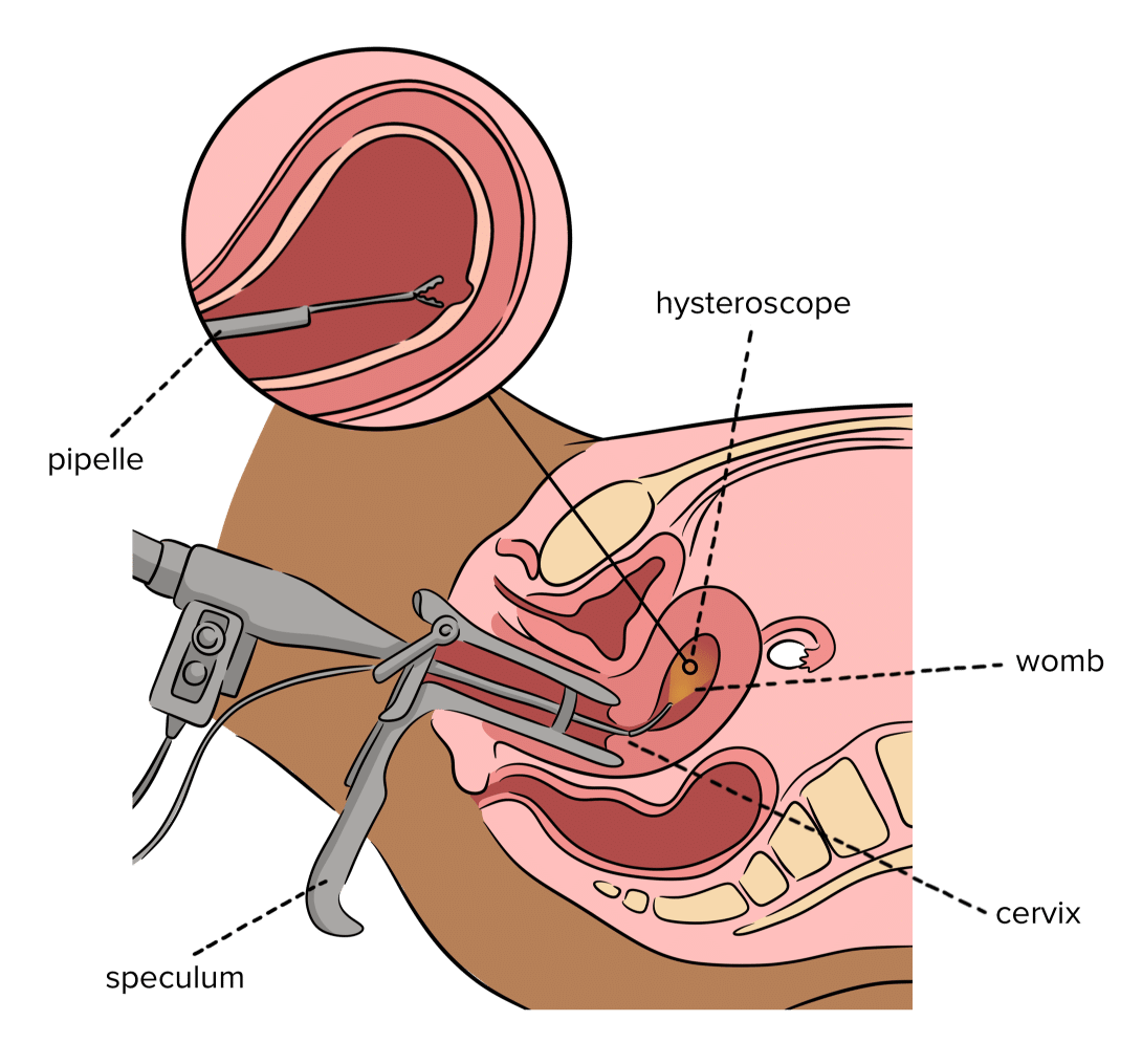 Hysteroscopy diagramannotated